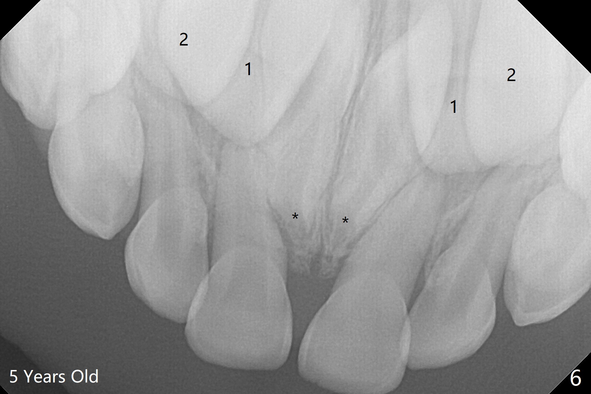When to Extract Mesiodens of a 3Yearold Boy? Duluth (Atlanta) GA
